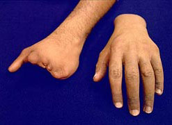 Amputacin parcial de mano equipada con guante cosmtico con relleno.